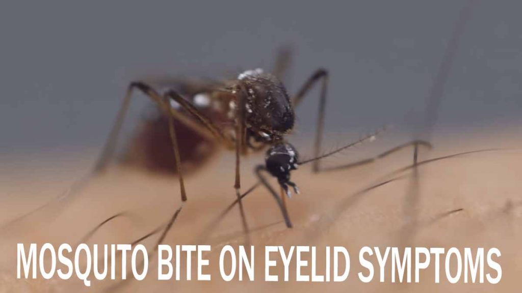 Mosquito Bite On Eyelid Symptoms