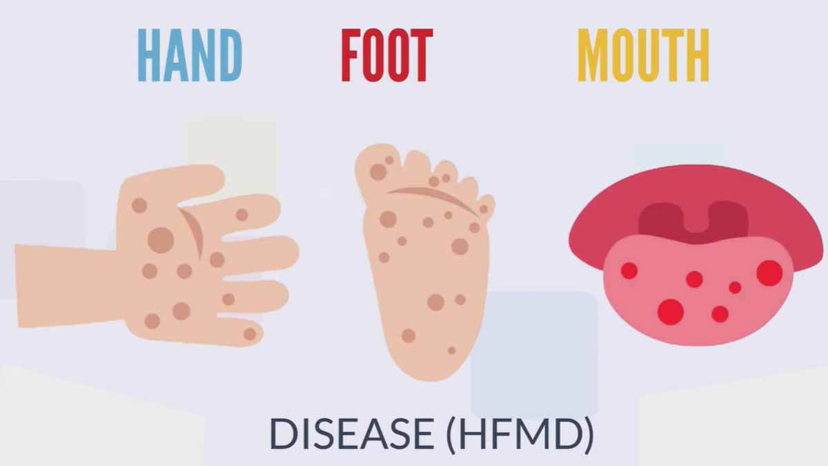 stages of hand foot and mouth disease in adults